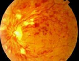 unhealthyretina
